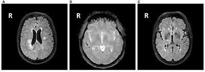 The Relationship between Cerebral Small Vessel Disease, Hippocampal Volume and Cognitive Functioning in Patients with COPD: An MRI Study